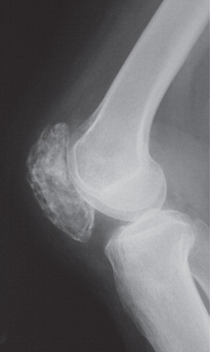 Figure 1. A lateral radiograph of the right knee. The right patella was enlarged, and its cortical shell was irregularly discontinued. Osteolytic and osteoblastic lesions were irregularly distributed in the patella.