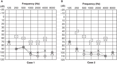 Figure 1. Pure-tone audiograms: (A) a 22-year-old female with a GJB2 mutation; (B) a 26-year-old male with an SLC26A4 mutation. There were no clear differences in hearing thresholds in these two cases.