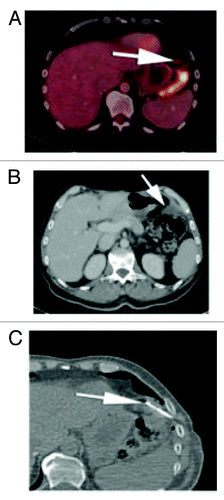 Figure 4. (A) Subsequent PET CT fusion image after 25 cycles showed no FDG avidity of the left upper quadrant soft tissue mass, favoring a good response to therapy (arrow). (B) Contrast enhanced CT performed soon after the PET image shown in Figure 6A showed interval increase in size of the left subphrenic metastasis. As there was disparity between an interval growth of the mass and lack of FDG activity, tissue sampling was recommended. (C) Intra-procedural CT scan shows the tip of a core biopsy needle (arrow) sampling the mass in the left subphrenic space. Pathology result was positive for viable disease.