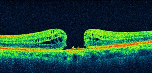 Figure 8 Optical coherence tomography image showed a full-thickness macular hole with complete vitreous detachment.
