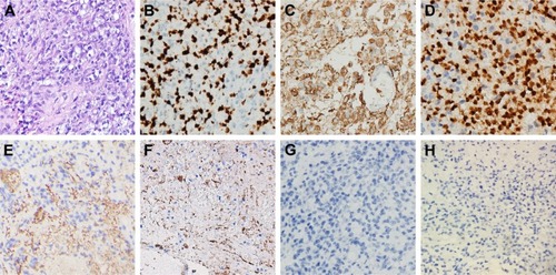 Figure 2 Histopathologic and immunohistochemical examinations of the biopsy tissue.Notes: (A) H&E stain showed features of anaplastic astrocytoma (WHO grade III) with increased cellularity, nuclear atypia, and mitotic activity. (B) MiB1 (Ki-67) immunohistochemistry showed high proliferative activity with 60% positive cells. (C) GFAP immunohistochemistry. (D) Oligo-2 immunohistochemistry. (E) VEGFR-1 immunohistochemistry. (F) VEGFR-2 immunohistochemistry. (G) CD117 (c-kit). (H) H3K27M immunohistochemistry. Staining was positive for GFAP, oligo-2, VEGFR1, and VEGFR2 and negative for c-kit and H3K27M. Magnification 400×.Abbreviation: VEGFR, vascular endothelial growth factor receptor.