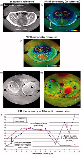 Figure 1. (a–c) Clinical example of MR-guided (B0 = 1.5 T) RF hyperthermia treatment of recurrent rectal carcinoma. (a) T1-weighted anatomical reference. (b) Uncorrected temperature distribution together with the contours delineating anatomical fat regions used for phase drift correction. (c) Corrected temperature distribution together with the contours delineating the tumour. For PRF thermometry, spoiled gradient echo images were acquired after an RF heating duration of 57 min, and temperature was calculated with regard to a reference phase map prior to the thermal therapy [Citation49]. (d–f) Influence of perfusion changes on PRF thermometry in comparison to fibre-optic temperature sensor readings in RF hyperthermia treatment of soft tissue sarcoma of the lower extremities. (d) T1-weighted anatomical reference and location of the fibre-optic temperature reading track. (e) PRF thermometry showing the temperature hotspot. For PRF thermometry drift corrected phase difference of spoiled gradient echo images towards a reference prior to the thermal treatment was evaluated [Citation106]. (f) Comparison of PRF thermometry and fibre-optic thermometry. Sincere under- and overestimation in PRF thermometry in the presence of perfusion decrease and increase can be seen. In the muscle reactive perfusion increases during RF hyperthermia (on the left side away from the tip). In tumours no or low reactive perfusion is expected, showing very good accuracy (<1 °C) between fibre-optic measurements and PRF thermometry. At the tumour margin perfusion declines (at the tip of the catheter), probably caused by the adjacent hyperperfused muscle (steal effect).