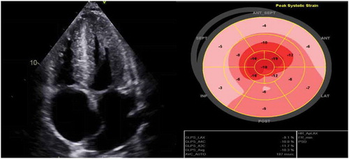 Figure 2. Echocardiogram demonstrating bi–atrial enlargement, biventricular hypertrophy, hypertrophied thickened interventricular septum and apical sparing on longitudinal strain