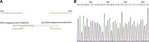 Figure 2 Accuracy verification of the novel SLC34A2-ROS1 fusion by Sanger sequencing.