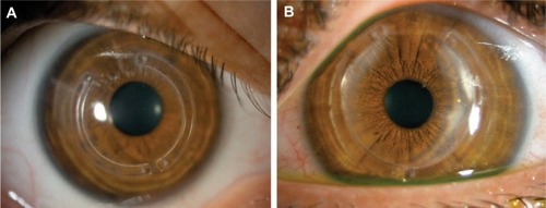 Figure 1 Implanted ICRS at the end of follow-up.Notes: (A) Implanted Intacs® ICRS. (B) Implanted Intacs SK ICRS.Abbreviations: ICRS, intracorneal ring segments; SK, severe keratoconus.