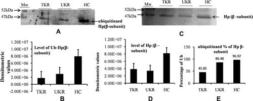Figure 5 Ubiquitination of haptoglobin (Hp) by Western blot analysis. (A) Representative Western blot image showing that there were decreased levels of ubiquitinated Hpβ in TKR/UKR compared to HCs. Ubiquitination of Hpβ was detected using antiubiquitin antibody after immunoprecipitated Hp had been separated on SDS-PAGE followed by Western blot. (B) Densitometry analysis showing decreased ubiquitination of Hp in TKR (0.22-fold) and UKR (0.37-fold) compared to HCs. (C) Silver-stained image of gel after running SDS-PAGE using purified Hp, indicating lower levels of Hpβ in TKR and UKR patients than HCs. (D) Densitometry analysis of gel image for Hpβ showing lower levels of Hpβ in TKR (0.47-fold) and UKR (0.41-fold) than HCs. (E) Ubiquitination percentages of Hpβ in TKR, UKR, and HCs, showing 45.85% Hpβ) ubiquitinated in TKR and 86.48% in UKR compared to 96.92% in HCs.