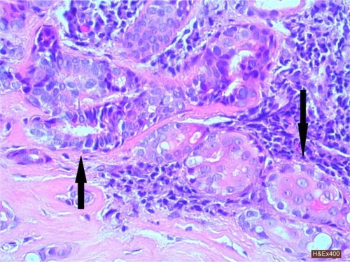 Figure 2 H&E stain (×400) of the tumor. Ductal structures lined by well differentiated columnar epithelium (up arrow) and solid squamoid nests with abundant eosinophilic cytoplasm (down arrow). There was minimal cytological atypia in either ductal or squamous component.