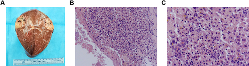 Figure 10 Surgical specimen and histopathological images. (A) The open resected specimen with liver tumor; (B and C) Pathological examination of tissue section; (B) 100 magnification; (C) 400 magnification.