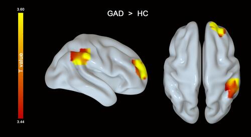 Figure 4 Patients with GAD displayed stronger functional connectivity between the left insula and the right superior frontal cortex and inferior parietal lobe than healthy controls.