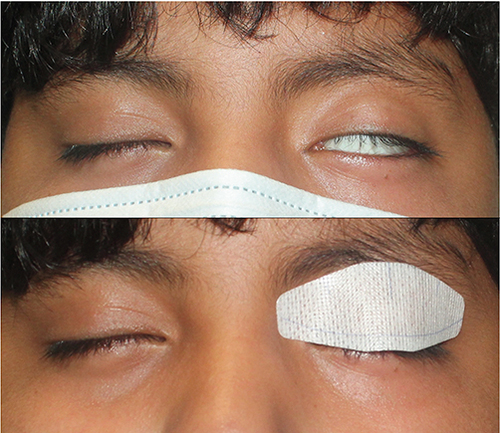 Figure 1 Proper placement of the NTP is demonstrated on the subject’s left upper eyelid, with the inferior border of the patch adjacent to the upper eyelid margin and above the eyelashes.