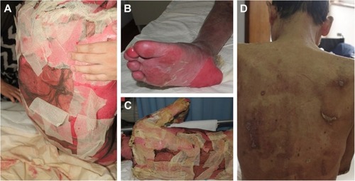 Figure 1 Skin rash before and after treatment.