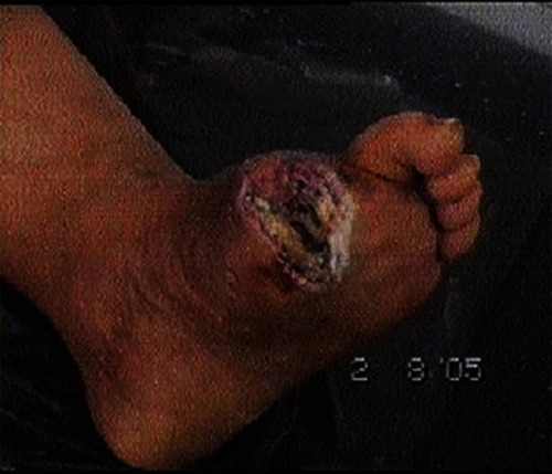 Photo 3 Lesion of patient 2 before treatment.