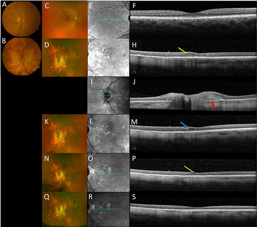 Figure 2 At the baseline, standard and ultra-wide color fundus photographs of the right eye had a normal appearance; however, the left eye showed disc edema with blurred margin and peripapillary chorioretinal atrophy (A–D). Although macular SD-OCT of the right eye was normal (E and F), the left eye showed preserved foveal contour but intraretinal edema (yellow arrow) and disruption of the ellipsoid zone (EZ) line (G and H). Spectral-domain optical coherence tomography (SD-OCT) through the optic disc showed elevated optic disc and subretinal fluid (red arrow) at temporal (I and J). In addition to the SD-OCT of optic disc improvement, intraretinal edema decreased in size and echogenicity (blue and Orange arrows), and the disrupted EZ line partially improved following the treatment at 2 months, 5 months, and the most recent visit (K–S).