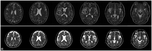 Figure 1. Horizontal sections of MRI image showing lesion areas in persons with brain injury. The person with right-brain injury (top) and the person with left-brain injury (bottom) showed unilateral reductions in signal in the area of the posterior insula (white circles). R denotes right.