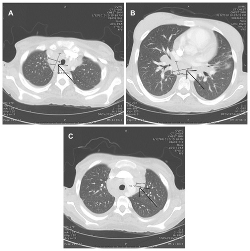 Figure 3 Imaging of the chest showing lymphadenopathy as of January 12, 2010: (A–C) multiple cuts of a computed tomography scan of the chest with intravenous contrast, showing multiple areas of perihilar lymphadenopathy and with the largest lymph node measuring 4.5 × 3.0 cm (arrows indicate lymphadenopathy).