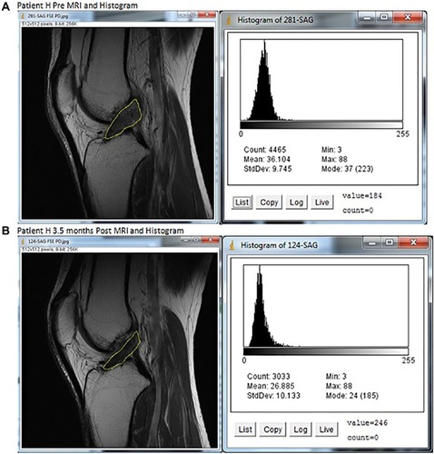 Figure 3 MRIs and histograms for Patient H, (A) pre- and (B) at 3.5 months posttreatment.