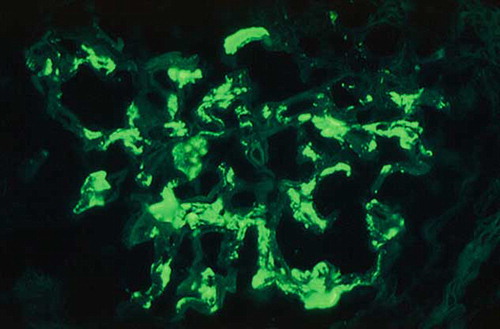 FIGURE 2. Direct immunofluorescence microscopy of a glomerulus showing intense granular staining for IgA in the mesangial areas (original magnification ×40).