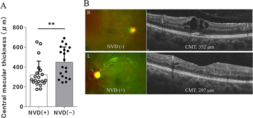 Figure 1 Comparison of central macular thickness (CMT) between proliferative diabetic retinopathy (PDR) patients with and without neovascularization of the optic disc (NVD). (A) Mean CMT in eyes with NVD was significantly lower than that in eyes without NVD (**P < 0.01). (B) This representative case shows a 29-year-old man with PDR in both eyes. His right eye has PDR without NVD and his left eye has PDR with NVD. The yellow arrow indicates NVD. On his initial visit, the CMT was 352 μm in his right eye and 297 μm in his left.