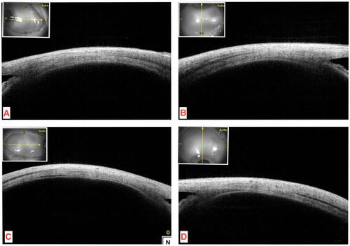 Figure 1 Normal extra ocular muscle insertions on SS-ASOCT. The medial (A), inferior (B), lateral (C) and superior rectus (D) muscles can be localized clearly along different distances on sclera.