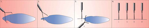 Figure 1. Zipper closure. Small or oval elongated lesions are clipped in a zipper fashion (30), starting in one corner and working clip by clip to the other corner. With every clip that is placed, the edges close to the clip are pulled a bit closer to each other, so the subsequent clips will easier reach the opposite wound margins.