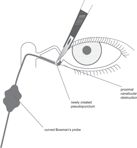 Figure 1 Diagrammatic representation of the modified retrograde dacryocystorhinostomy technique. A blunt-tipped ‘O’ gauge probe, the distal 1.5 cm of which is at right angle, is inserted retrogradely into the common internal opening and passed in the direction of the lower canalicular system. Note the scalpel which is used to cut down onto the probe tip and create a pseudopunctum.