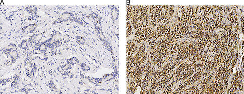 Figure 4 IHC analysis of KIF20A expression in tumor tissues of ER-positive BC patients. (A) Representative image showing low expression level of KIF20A (×200). (B) Representative image showing high expression level of KIF20A (×200).