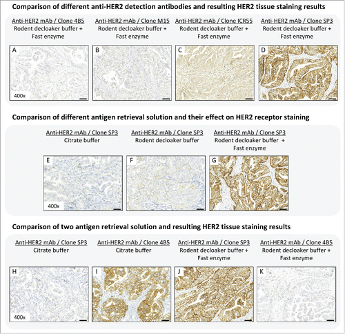 Figure 1. (A-D) Binding affinity and specificity of different anti-HER2 antibody clones in Calu-3 tumor xenograft. Antigen retrieval was performed with rodent decloaker buffer and fast enzyme solution. (E-G) Influence of different antigen retrieval buffer on HER2 tissue staining results in Calu-3 tumor xenograft. The anti-HER2 antibody clone SP3 was use for target detection. (H-K) Comparison of 2 antigen retrieval solution and resulting HER2 tissue staining results in Calu-3 tissue slices. Antigen retrieval using citrate buffer followed by HER2 staining with anti-HER2 mAb clone SP3 (H) and anti-HER2 mAb clone 4B5 (I). Antigen retrieval using rodent decloaker plus fast enzyme followed by HER2 staining with anti-HER2 mAb clone SP3 (J) and anti-HER2 mAb clone 4B5 (K) showed contradictory staining results. Magnification of the tissue slices: x400. Scale bar: 50 µm.
