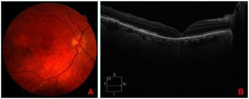 Figure 3 Post-surgical follow-up. (A) Three months after treatment with PPV + PRGF membrane. (B) Retinography of the right eye: Image of closed macular hole, macular pigmentary changes.