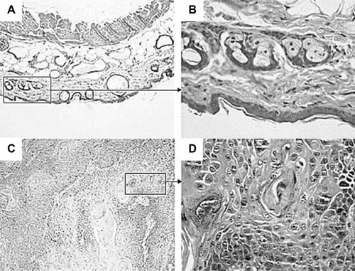 Figure 1 Histopathological examination of normal and cancerous skin.Notes: The normal skin showing clear and complete structures: (A) 100× and (B) 400×. Squamous cell carcinoma tissue showing a large number of atypia cells, pathological mitotic, and keratosis beads: (C) 100× and (D) 400×.