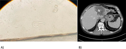 Figure 1 (A) Light microscopy picture of Strongyloides stercoralis larvae recovered from stool of patient 1.* (B) Computed tomography showing Echinococcus multilocularis infestation of patient 3. *Reference: Division of Infectious Diseases and Tropical Medicine, Medical Center of the University of Munich (LMU), Germany.