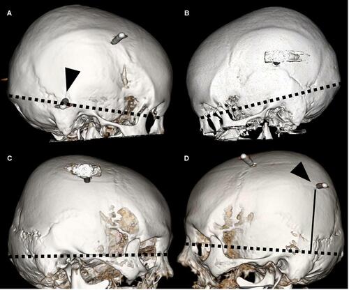 Figure 2 Position of most caudal head pins in representative patients with and without slippage. (A and B) Patient without slippage. Most caudal pin (arrowhead) is located near the nasion-inion line (dotted line). (C and D) Patient with slippage. Most caudal pin (arrowhead) is located >4.5 cm vertically (black line) from nasion-inion line (dotted line).