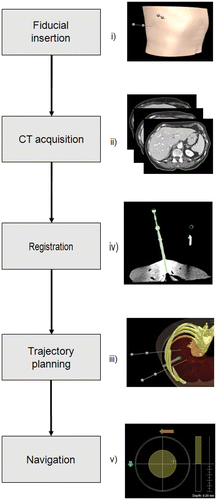 Figure 1. Workflow for navigated needle placement. Prior to the intervention, a set of fiducial needles is inserted in the vicinity of the target. Next, a planning CT scan is acquired and a trajectory to the target is planned. Finally, the image coordinate system is registered with the tracking coordinate system based on the fiducial positions. During the intervention, the fiducial needles are continuously located by an optical tracking system and a real-time transformation is used to estimate the position of the target point accordingly. A suitable visualization scheme guides the physician towards the moving target. [Color version available online.]