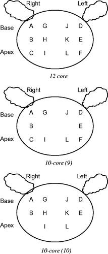 Figure 1. Location of prostate biopsy schemes. A: Right base lateral, B: Right middle lateral, C: Right apex lateral, D: Left base lateral, E: Left middle lateral, F: Left Apex lateral, G: Right base middle, H: Right middle middle, I: Right apex middle, J: Left base middle, K: Left middle middle, L: Left apex middle.