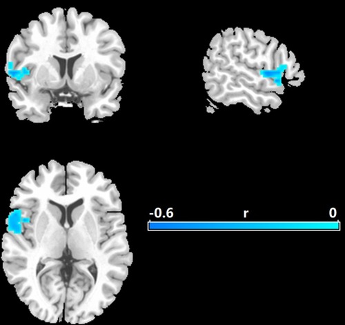 Figure 2 Correlations between entropy and the Hamilton rating scale for MDD. Significance level was defined at voxel p < 0.005, cluster p < 0.05, GRF corrected. L refers to the left side of the images in the coronal, and horizontal sections correspond to the left side of the brain.