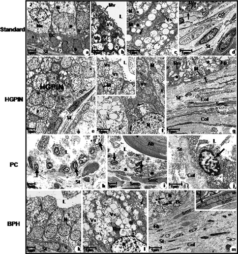 Figure 2.  Electron micrographs of the prostatic peripheral zone from standard (a, b, c, d), HGPIN (e, f, g), PC (h, i, j) and BPH (k, l, m) groups. (a) Columnar cells with basal nuclei and clear nucleoli (Nu); Basal cells (Bc). Stroma (St). (b) Often secretory vesicles; short and scattered microvilli (Mv). (c) Flattened and parallel Golgi cisternae (arrow) with secretory vesicles. (d) Rough endoplasmic reticulum cisternae (RER). Basal lamina (arrow); Stroma with collagen fibres (Col) underlying the epithelium and among smooth muscle cells (Smc) and fibroblast (Fb). (e) HGPIN; Basal cells (Bc). (f) Dilated Golgi cisternae (arrow); inset: Ruptured mitochondrial cristae. (g) Dilated rough endoplasmic reticulum cisternae (RER). Digestory vacuoles (asterisk); Basal laminal (arrow); Increased collagen fibres (Col) distributed among smooth muscle cells (Smc). (h) Neoplastic cells with increased nuclei (arrow). (i) Neoplastic nuclei (arrow); amylaceous bodies (Ab); interrupted basal lamina (asterisk); Smooth muscle cells (Smc) showing irregular feature and collagen fibres (Col). (j) Neoplastic cell with increased nuclei and rare cytoplasm (arrow); Increased collagen fibres (Col). (k) Columnar cells. (l) Dilated rough endoplasmic reticulum cisternae (Rer) and Golgi (arrow). Digestory vacuoles (asterisk). (m) Basal cells (Bc); Digestory vacuoles (arrow) in the cellular cytoplasm; Increased collagen fibres (Col) and fibroblast (Fb) and smooth muscle cells (Smc); inset: smooth muscle cells showing spinous feature (Smc). a–m: L, lumen; M, mitochondria; N, nucleus; St, stroma and Vs, secretory vesicles.