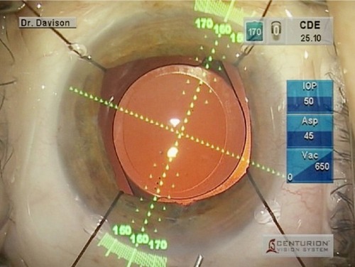 Figure 1 The VERION™ Image Guided System microscope overlay for toric intraocular lens alignment.