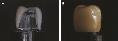 Figure 6 Fracture modes of the crowns: (A) complete fracture in M, SM0.3, and SMC groups and (B) cohesive veneer fracture in SMW and SM0.5 groups.