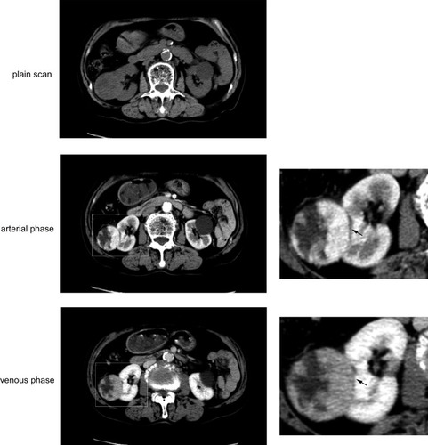 Figure 1 Pseudocapsule on MDCT. A 71-year old man with right renal cancer. ctPS is quite clear in arterial phase (black arrow), blurry but distinguishable in venous phase (black arrow). A simple renal cyst is also seen on the left kidney.