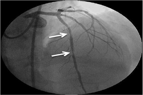 Figure 4 Conventional coronary angiography showing a left coronary angiogram. The anteroposterior cranial view showed two successive stenotic lesions with 90% stenosis of the mid-segment of the left anterior descending (LAD) artery (arrows show the stenotic segments).