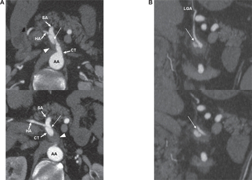 Figure 1 A) Axial contrast-enhanced computed tomography scan through upper abdomen shows an intimal flap (arrow) in the celiac trunk (CT) causing moderate vessel narrowing, with aneurysmal formation, mural thrombus (arrowhead), and increased attenuation of the surrounding fat. Findings are consistent with celiac artery dissection. The abdominal aorta (AA) is intact. HA denotes hepatic artery; SA denotes splenic artery. B) Coronal reformatted computed tomography images show the celiac artery dissection (arrow) with associated thrombus involving false lumen. LGA denotes left gastric artery.