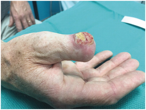 Figure 2. Initial patient presentation to the plastic surgery clinic in August of 2017 post initial surgery demonstrating the recurrence of the lesion on the dorsum of the right thumb interphalageal joint.