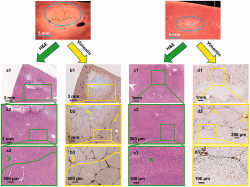 Figure 3. Gross pathology along with H&E and vimentin stains created using sonication parameter sets F (panels a & b) and C (panels c & d). Vimentin stains for mesenchymal cells and is a surrogate for tissue viability. Panel b shows substantial damage of tissue beyond the focal region (panel b2, yellow arrowhead) even though H&E indicates intact tissue (panel a3 green arrowhead). In contrast, panel c shows structurally intact tissue around the focal region and panel d depicts viable tissue in this intact region (green and yellow arrowheads in panels c3 & d2 respectively).