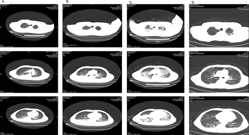 Figure 1 Chest CT Scan: (A) the first column, August 20th; (B) the second column, August 26th; (C) the third column, August 29th; (D) the fourth column, September 22nd.
