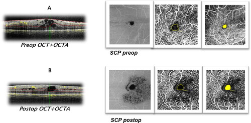 Figure 3. Preoperative (A) and postoperative (B) OCT + OCTA of SCP in a patient with ERM. The structural OCT shows ERM with cystoid intraretinal changes and absence of foveal pit, and preoperative OCTA of SCP demonstrate distotsion and reduction in the FAZ area before surgery (A). Structural OCT shows residual intraretinal changes after ERM removal (B). Note: OCT: optical coherence tomography; OCTA: optical coherence tomography angiography; SCP: superficial capillary plexus; FAZ: foveal avascular zone.