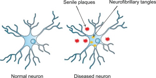 Figure 1 A normal neuron (left) and an Alzheimer’s disease-affected neuron (right).