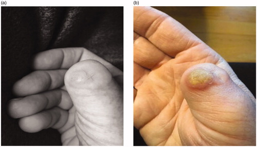 Figure 3. (a,b) Images taken two weeks apart showing aggressive re-occurrence of the lesion after the second surgery in April of 2018.