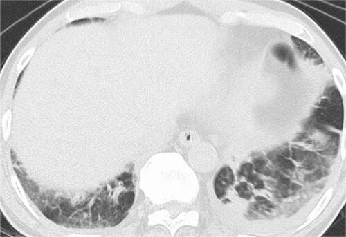 Figure 4 Chest CT with the lung window setting shows ground-glass shadows and infiltrations in bilateral lower lung fields.