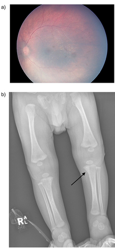 Figure 1 Typical features of congenital syphilis. (a) Chorioretinitis as evidenced by mottled “salt and pepper” pigmentary retinal changes on fundoscopy. (b) Early erosions of the mid metaphysis of the distal femur and medial proximal tibia (Wimberger’s sign – see arrow) and generalised periostitis on long bone X-ray. Reprinted from Wu MX, Moore A, Seel M, et al. Congenital syphilis on the rise: the importance of testing and recognition. Med J Aust. 2021;215(8):345–346 e341. © 2021 AMPCo Pty Ltd.Citation19