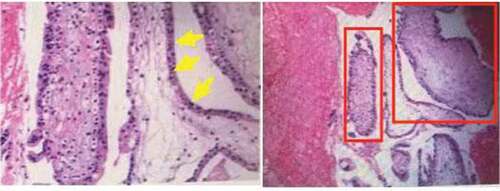 Figure 2. Pathological section image of the patient. The perivillous trophoblasts were severely hyperplastic (the yellow arrows), and the villi were edematous and enlarged (inside the red boxes).