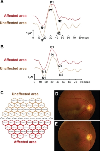 Figure 1 The representative mfERGs before and after TES and mfERGs are divided into two response groups are shown. The representative changes of the mfERGs before (A) and after (B) three sessions of TES. After TES, the mfERGs in the affected area are improved (red line). The all trace arrays are divided into two groups (C); the affected areas (red boxes) and unaffected areas (brown boxes) by the horizontal line. The amplitudes of N1–P1 and N2 in the affected and unaffected areas were measured, and the ratio of the sum of the affected areas and of the unaffected areas were calculated. In the same way, we summed the implicit times of N1, P1, or N2 in each area and calculated the ratio of affected area and unaffected area. The fundus photographs before (D) and after (E) TES in the fresh case (No. 4 case in Table 1). The retinal opacity was found in the lower macular area before TES (D). Twenty-four months after TES, the retinal degeneration appeared corresponding to the ischemic lesion, but any other retinal changes did not occur.